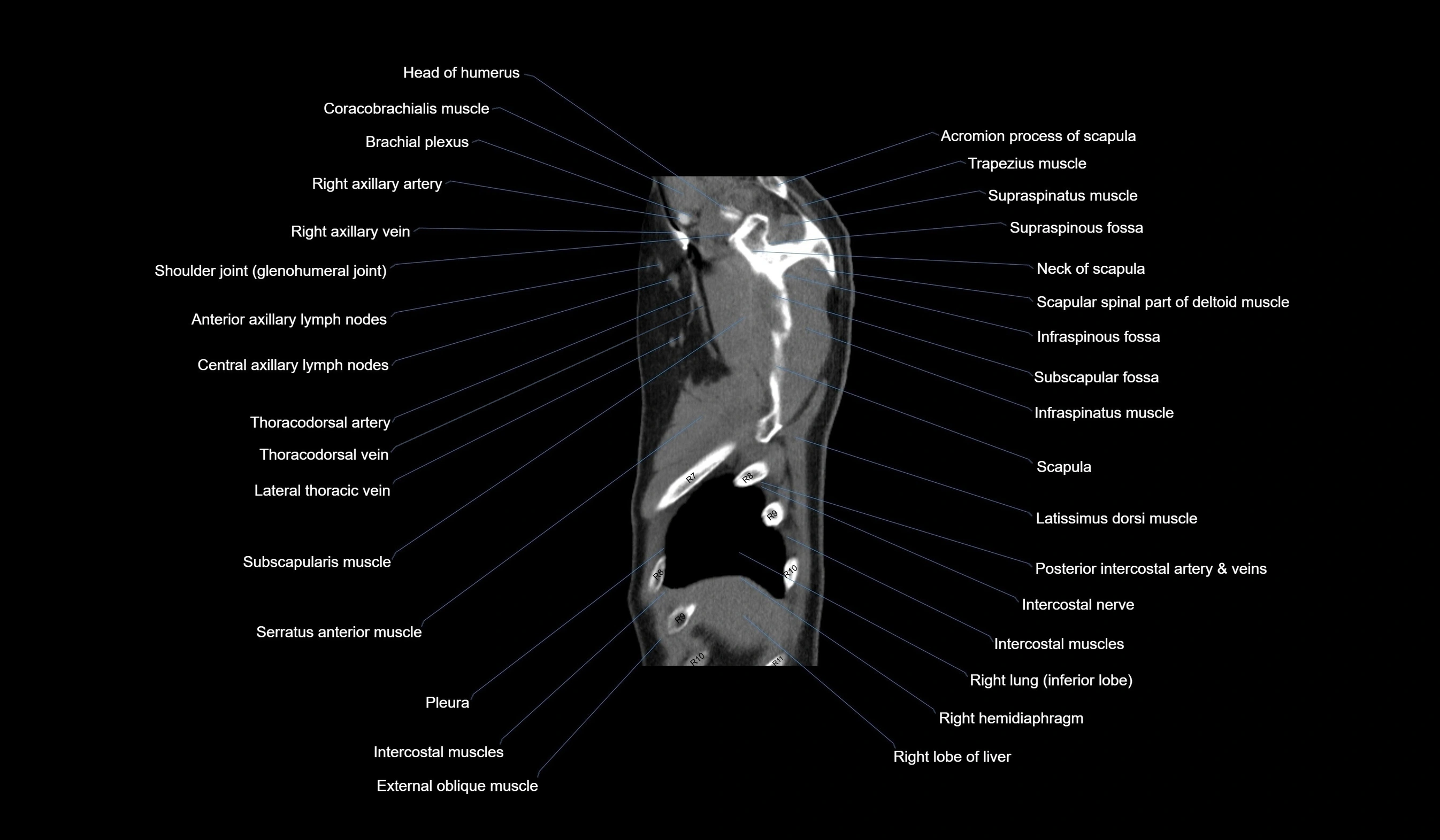 CT chest (thorax) labelled sagittal cross sectional anatomy radiology image-00015.webp